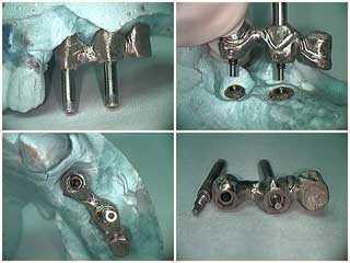 New York Dental Implants teaches trying in the dental implant framework for a porcelain metal bridge and implant prosthetics.