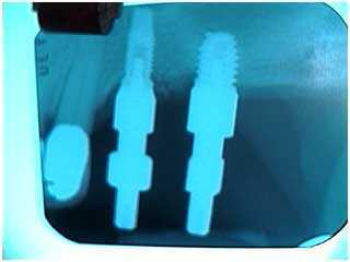 New York Dental Implants teaches dental implant impression copings x-ray of the implant prosthetics connection and a porcelain bridge
