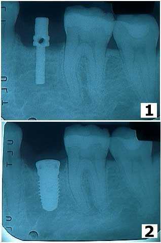 dental Implant Surgery single tooth Implants, X-ray, angulation pin placement xray