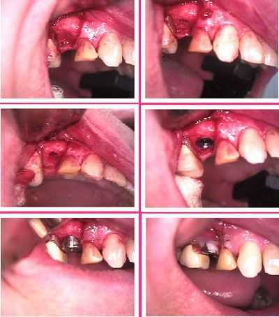 dental implant oral surgery, stage 1 one, vertical releasing incision, bone exposure, healing collar