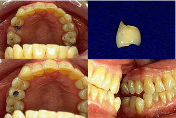 dental implant single tooth replacement, connecting screw, Dr. Neal Gittleman porcelain crown