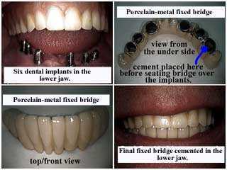 New York Dental Implants pictures on a fixed porcelain bridge dental implants caps or crown in a full mouth reconstruction.