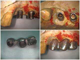 dental implants, how to pictures, teeth implant prosthetics, metal framework try in crown bridge