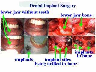 dental implants, hybrids, bone evaluation, first 1st stage 1 one, oral surgery surgeon