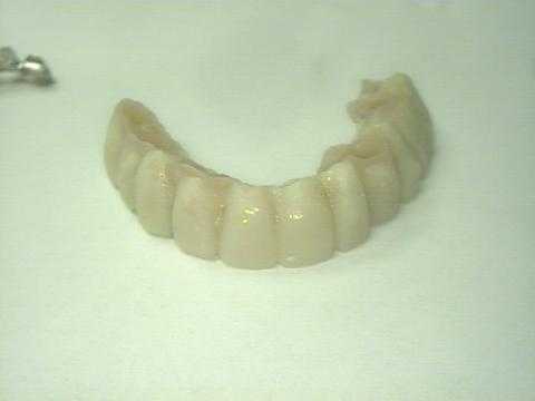 dental implants, implant prosthodontics, prosthetics, provisional temporary acrylic bridge dental 