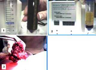 platelet concentration freeze-dried bone, thrombin centrifuge centrifuged fibrin glue oral surgery