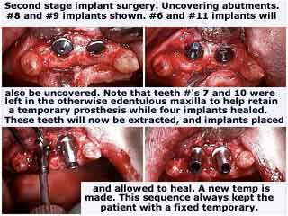 New York Dental Implants shows Second stage dental implants oral surgery for the stage 2 uncovering abutments treatment.