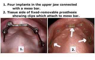 dental Implants prosthetics, hybrid, attachments, meso bar clips implant denture prosthesis