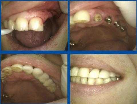Dental implants, reconstruction, fixed bridge, teeth over dental implants, tooth replacement