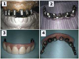 dental implants, second stage abutment connection, titanium implant, frame, framework model