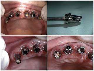 dental implants, second stage 2, parallel abutments, connection, parallelism, how to pictures