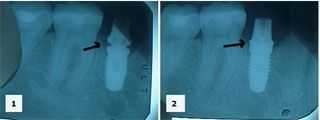 Dental implants single tooth dental implant, second stage abutment x-ray xray radiographic
