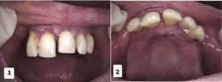 jawbone evaluation, alveolar ridge jaw cortical plate, maxillary dental implant surgery sinus lift