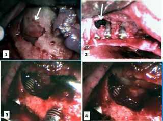 dental implants implant oral surgery sinus elevation lift fibrin glue platelet plasma bone graft