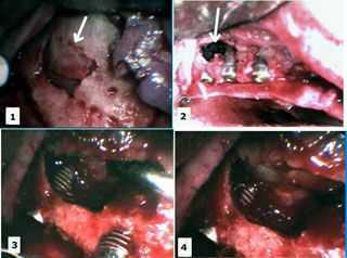 dental implants surgery, sinus lift elevation, bone graft, platelet-rich plasma, PRP