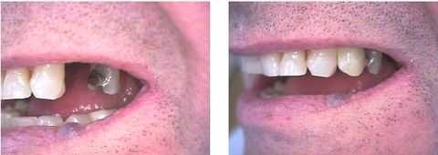 dental implants, temporary crown, temporary teeth dental implants, flipper