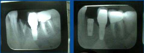 dental implants xray, x-ray radiographic artificial titanium tooth replacements x-rays xrays