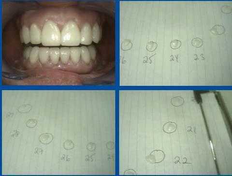 porcelain teeth veneers dental laminates tooth method how step by step pictures technique photos