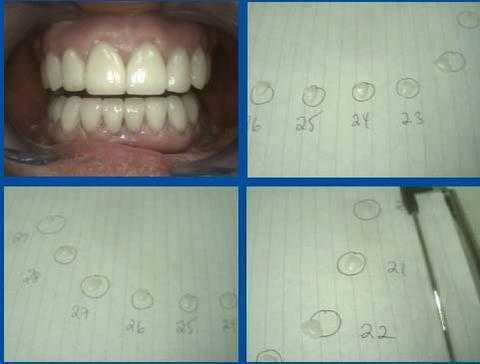 NY dental veneers laminates tooth teeth veneer porcelain master models how to technique method steps