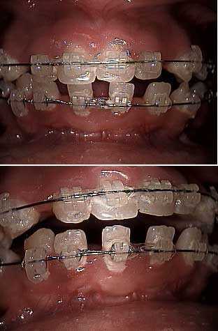 tooth alignment, ceramic orthodontic brackets braces, spaces, protrusion, midline, anchorage