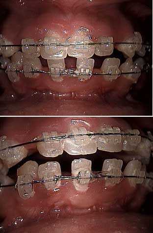 Faster braces orthodontics for buck teeth spacing. Anchorage elastics for a protruded midline.