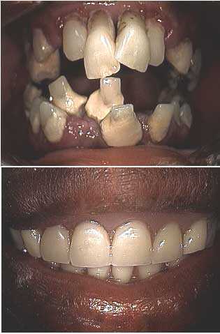 collapsed bite, dental occlusion, teeth malocclusion dentist fear, phobia, dental anxiety