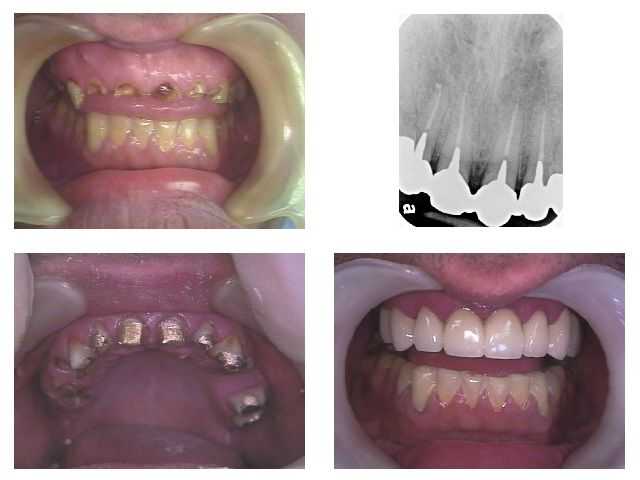 fear of dentists dental phobia, fear, smile makeover, oral rehabilitation, reconstruction, anxiety
