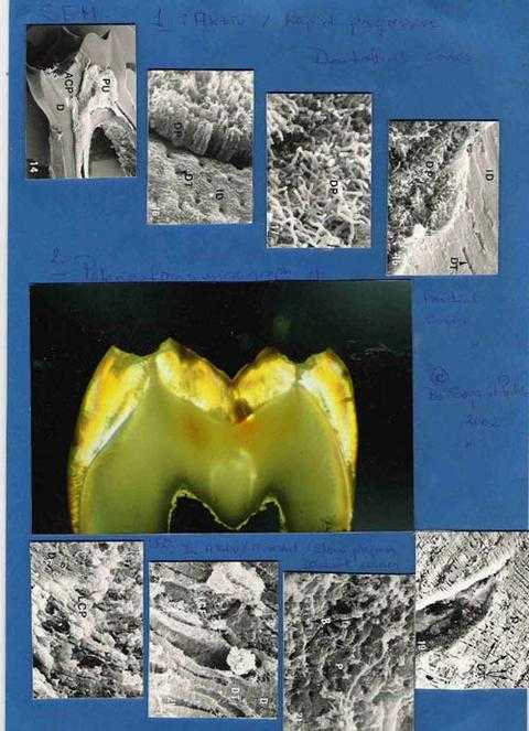 dental photomicrographs, SEM, Scanning Electron Micrographs, proteolytic, foci  liquefactions
