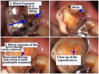 root canal therapy tooth pain swollen jaw abscess direct pulp nerve exposure teeth abscess cavity