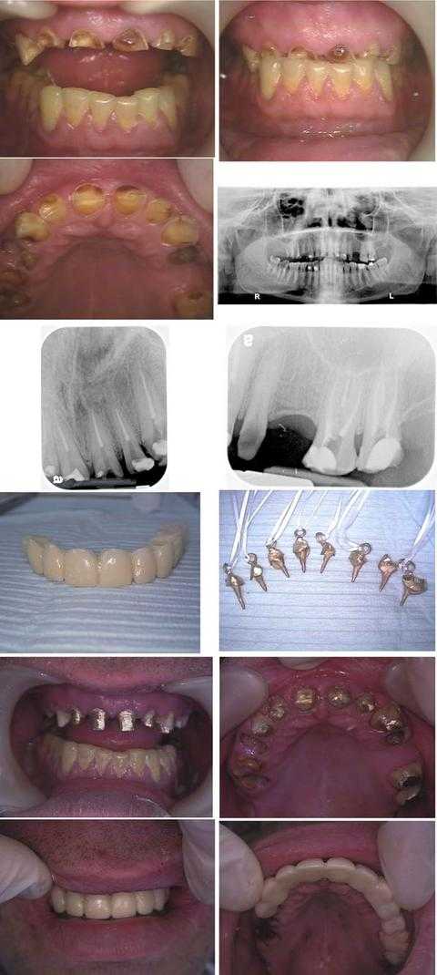 cast gold post and core dental reconstruction, phobia, smile makeover, teeth tooth pictures