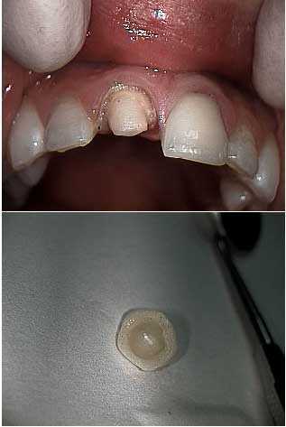 resin dental cements in dentistry, Nexus, compomer, all porcelain dental crowns caps, jacket tooth