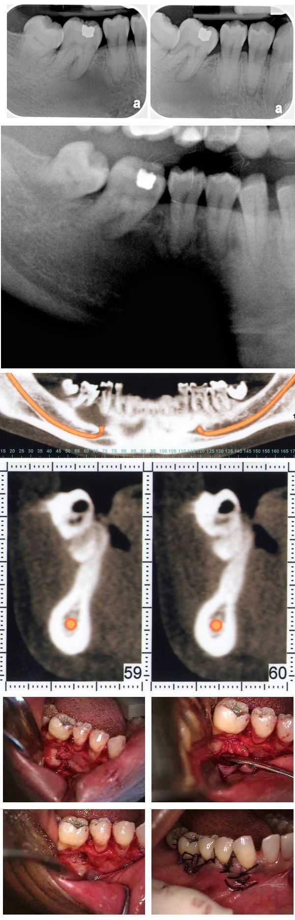 dental tooth abscess teeth, lateral periodontal cyst, mild inflamed fibrous tissue, CAT ct scan