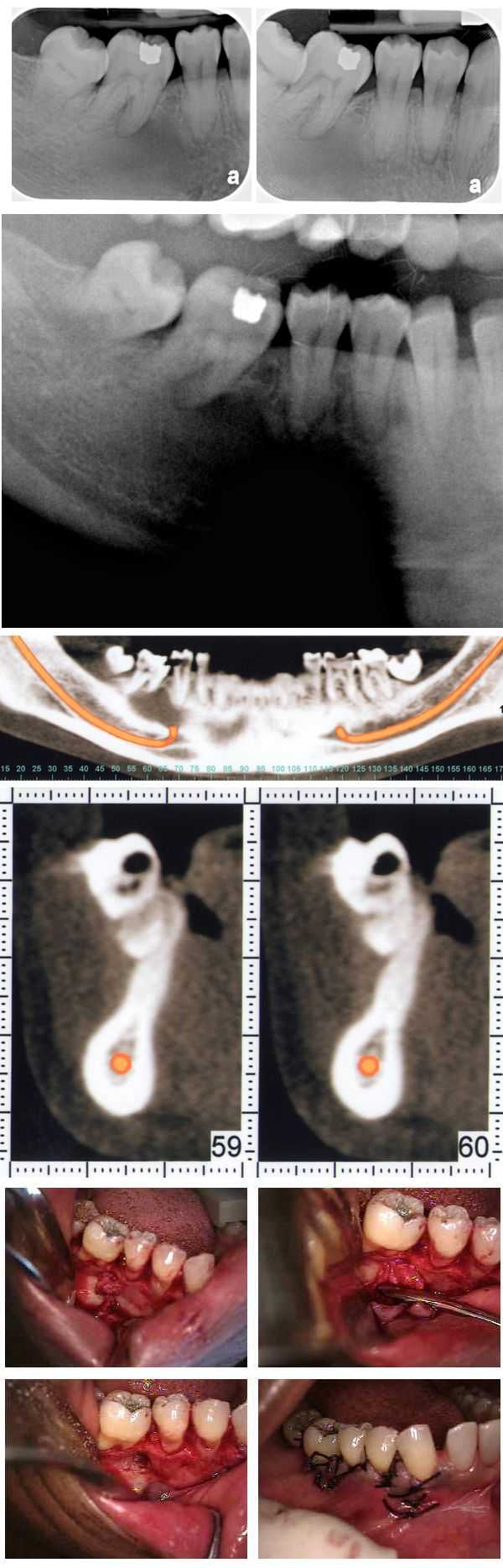 Complications in dentistry, dental diagnosis, lateral periodontal cyst, mild inflamed fibrous tissue