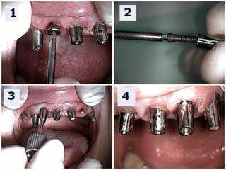 New York Dental Implants shows a second stage dental abutment connection and cover screw or healing cap removal.