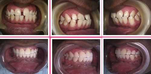 dental laminates teeth porcelain laminate tooth veneers veneer before and after Lumineers