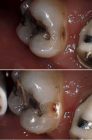 interproximal decay cavity caries decalcification discoloration color stain staining