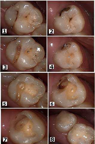 Dentistry Diagnosis tooth Decay Cavity dental Caries teeth Bonding Cavity drill Technique diagnose