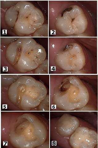 composite resin tooth white fillings, Molar tooth Decay, Cavity, Bonding, Cavity Preparation Dentist