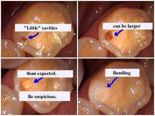 dentistry procedures, size of tooth cavity bonded dental, bonded cosmetic dentistry 