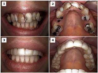 oral rehabilitation dental reconstruction smile makeover crowns caps bridge Dr Dorfman