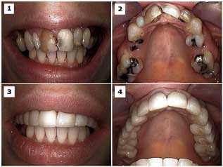 bridges full mouth reconstruction, fixed porcelain metal caps crowns ceramic, pfm, Phobic Patient Roundhouse, full arch