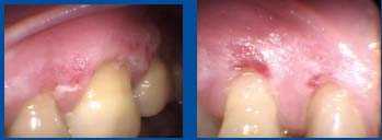 dermatitis, desquamative gingivitis, bleeding gums, itching gums, periodontium periodontal