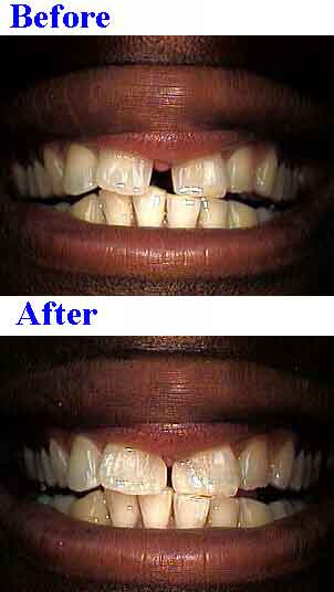 diastema, front tooth gap, bonding gaps to close spaces, composite resins
