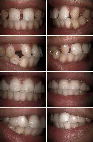dental crown bridges bridge caps crowns close tooth gaps spaces diastema gaps gapped teeth