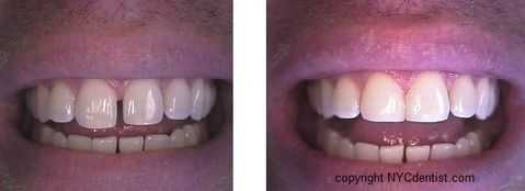 diastema, fix tooth gap, teeth space treatment, dental bonding to close gap