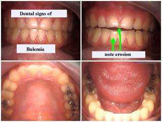 diet, nutrition, bulimia, bulemia, enamel erosion, stomach acids, vomiting, regurgitatiion, fruit ju