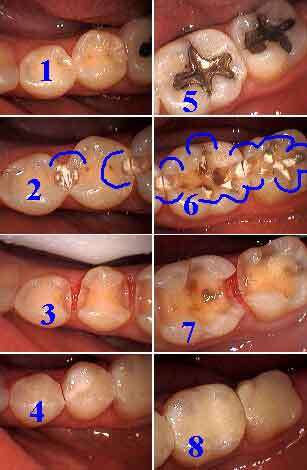 teeth decalcification tooth cavity cavities dental caries interproximal incipient lesion white spot