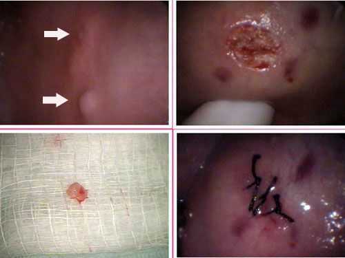 Differential diagnosis aphthous ulcer canker sore fibroma excisional biopsy pictures symptoms, dani