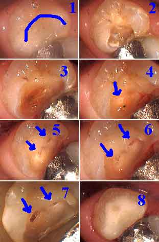 root canal therapy tooth pain swelling abscess direct pulp nerve exposure cap cavity decay teeth