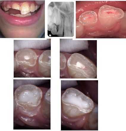 direct pulp exposure of the dental nerve, Pediatric Endodontics, root canal therapy for children